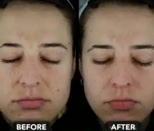 Before-and-after Collagen P.I.N. | Seattle Aesthetics | Seattle