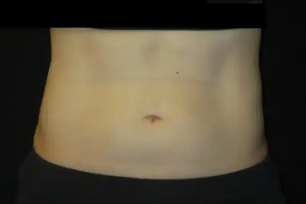 Before CoolSculpting |Seattle Aesthetics |Seattle