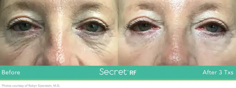 Before and After Secret-RF Microneedling Treatment Result | Seattle Aesthetics | Seattle