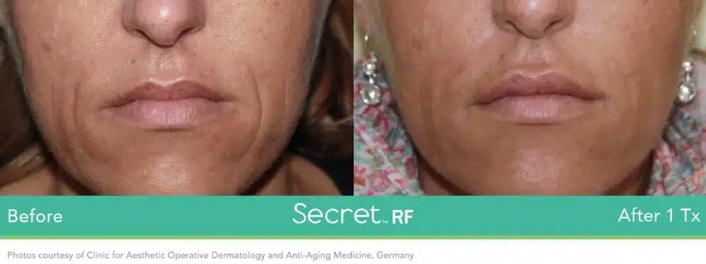 Before and After Secret-RF Microneedling Treatment Result | Seattle Aesthetics | Seattle