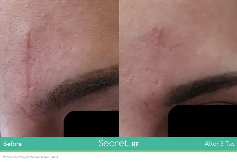 Before and After Secret-RF Microneedling Treatment Result | Seattle Aesthetics | Seattle