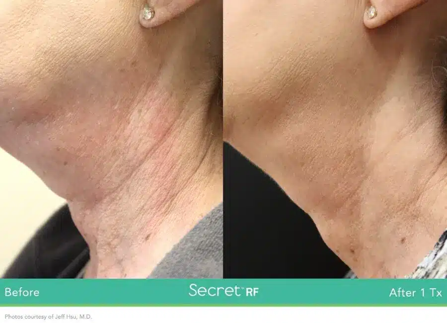 Before and After Secret-RF Microneedling Treatment Result | Seattle Aesthetics | Seattle