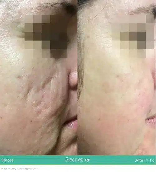 Before and After Secret-RF Microneedling Treatment Result | Seattle Aesthetics | Seattle