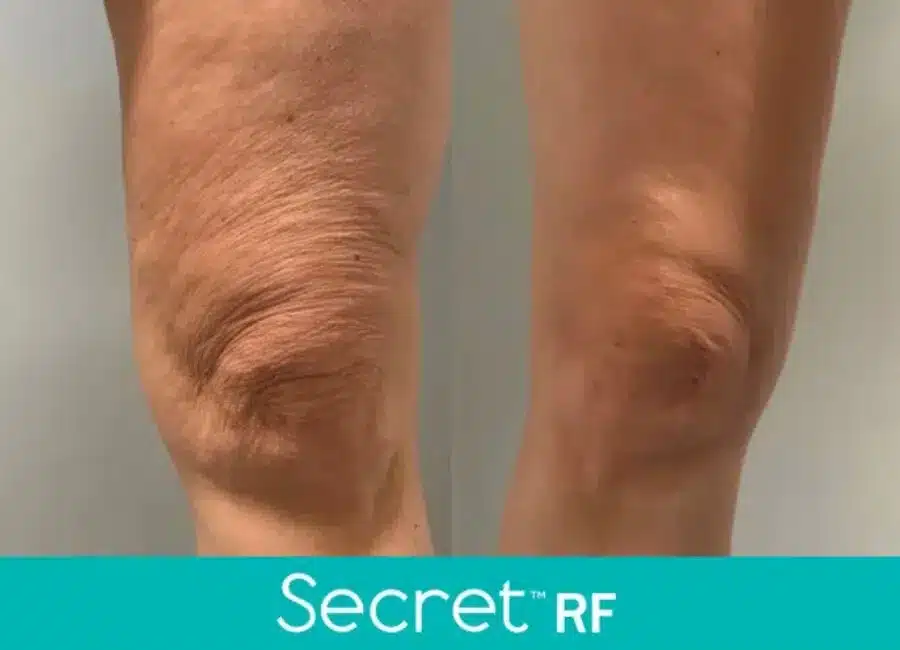 Before and After Secret-RF Microneedling Treatment Result | Seattle Aesthetics | Seattle