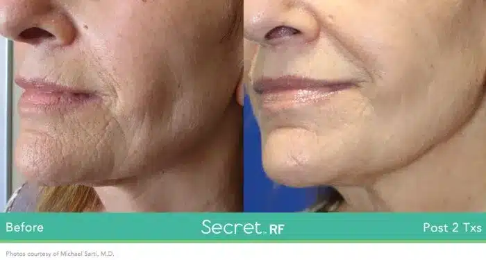 Before and After Secret-RF Microneedling Treatment Result | Seattle Aesthetics | Seattle, WA