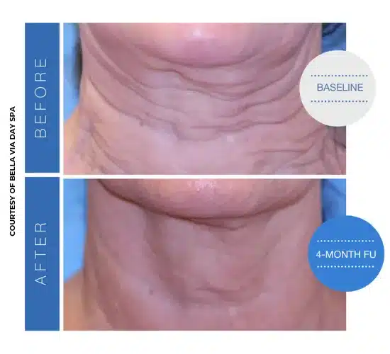 Before and After Sofwave™ Treatment Result | Seattle Aesthetics | Seattle