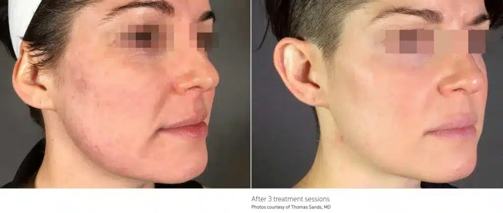 Before and After TriLift™ Treatment Result | Seattle Aesthetics | Seattle