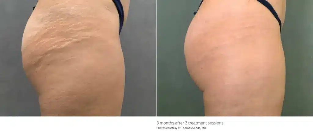 Before and After CoolSculpting Treatment Result | Seattle Aesthetics |