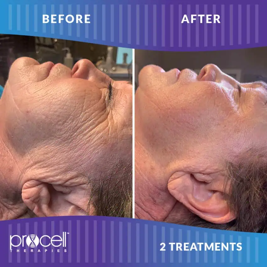 ProCell Microchanneling before and after images 4th | Seattle Aesthetics | Seattle WA