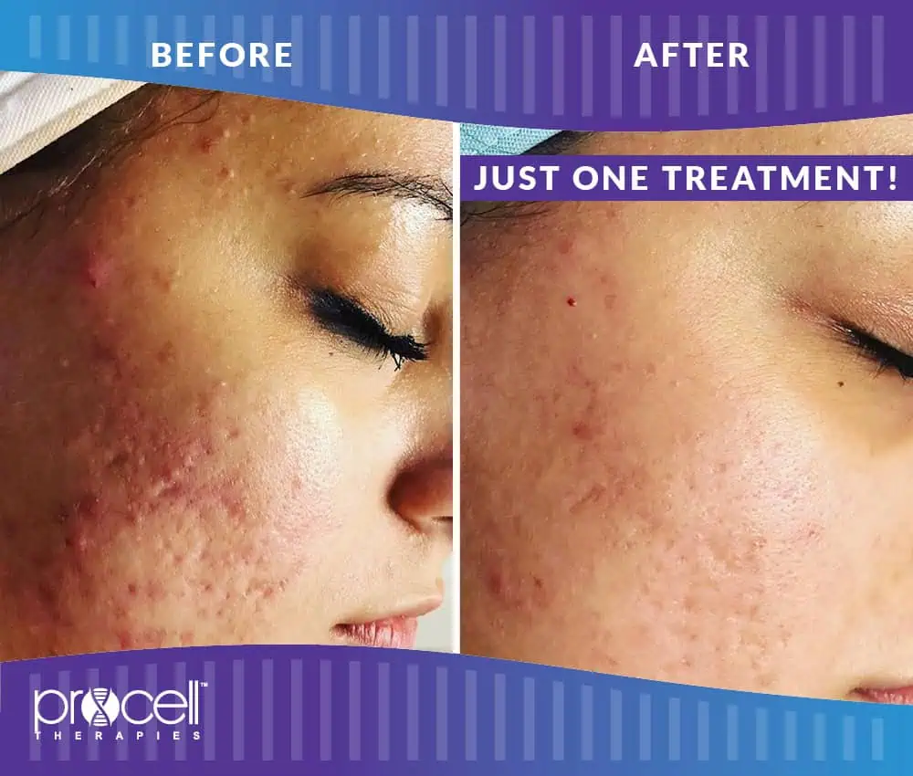 ProCell Microchanneling before and after images 3rd | Seattle Aesthetics | Seattle WA