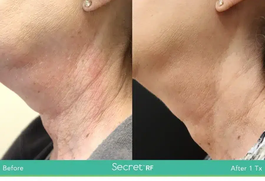 Before and After Secret-RF Microneedling Treatment Result | Seattle Aesthetics | Seattle