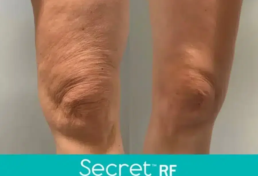 Before and After Secret-RF Microneedling Treatment Result | Seattle Aesthetics | Seattle