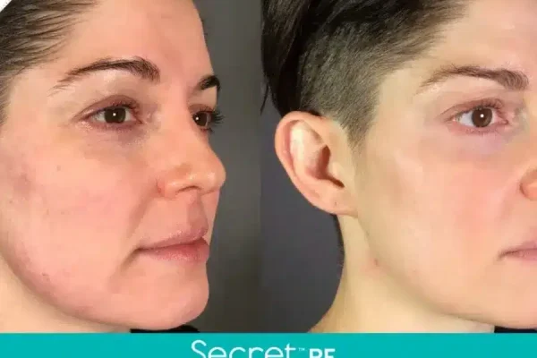 Before and After Secret-RF Microneedling Treatment Result | Seattle Aesthetics | Seattle