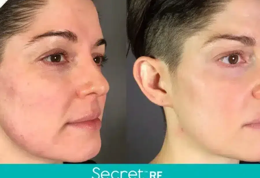 Before and After Secret-RF Microneedling Treatment Result | Seattle Aesthetics | Seattle